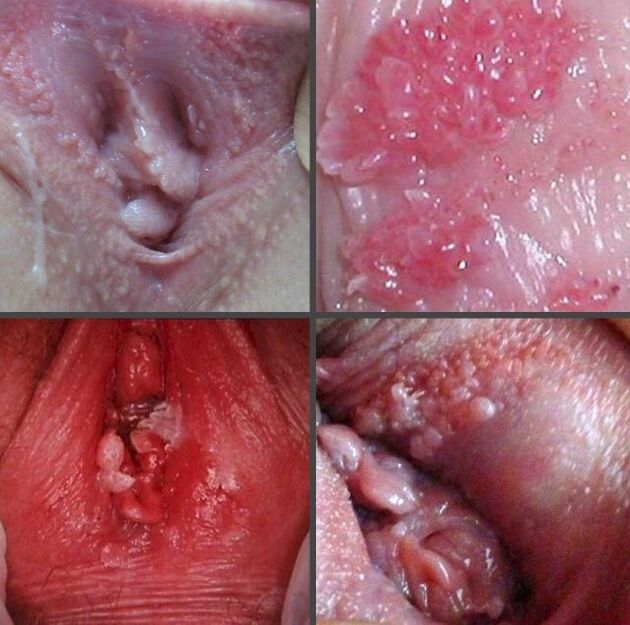 Cerca del papiloma en la vagina