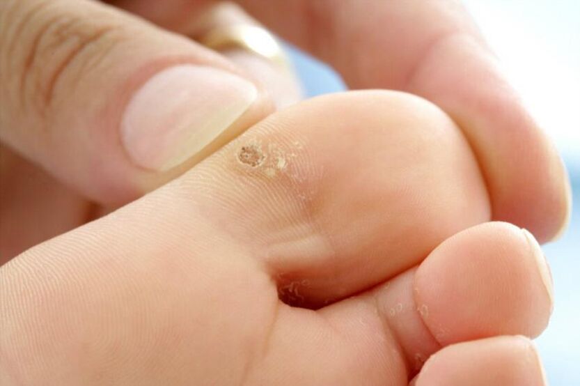 verrugas en los dedos de los pies