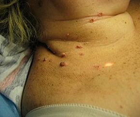 Virus del papiloma humano en el cuello